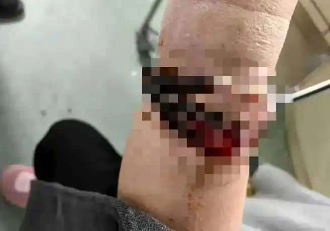 女子带手镯10年没摘竟“长”进了肉里！医生：再晚点手就保不住了