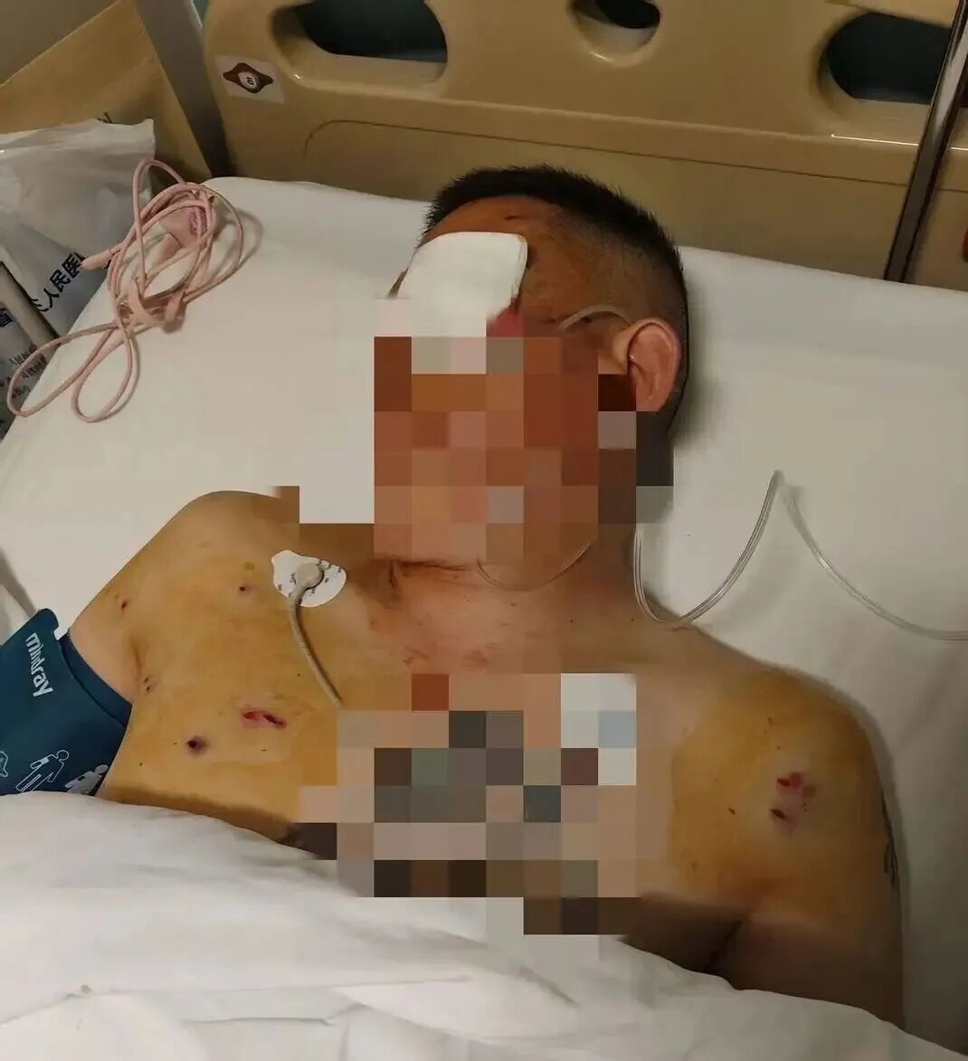 中国农业银行中牟县支行回应客户遭抢事件_取170万遭抢当事人:歹徒照头就一枪_男子取款170万银行门口遭抢致重伤 银行保安未帮忙应担责