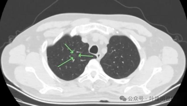 32岁儿子陪护69岁母亲双双确诊肺癌 早筛挽救生命