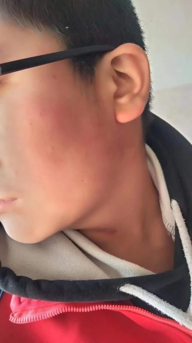 男孩遭老师掌掴致九级伤残 家长曾嘱咐勿打头部