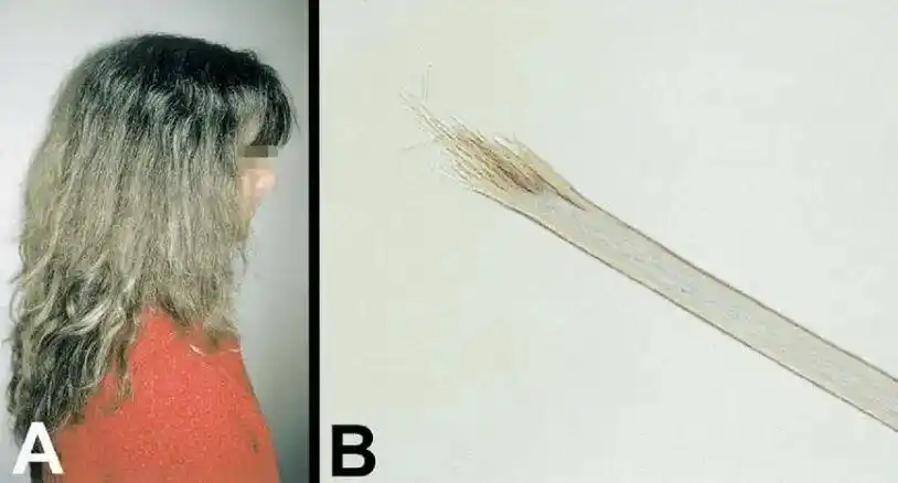 头发分叉原因_毛干异常修复方法_头发开叉其实是种病