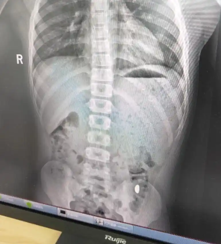 江苏11岁男孩误吞10克重黄金豆,第6天就医后排出,妈妈:天天叮嘱他不要在外面上厕所