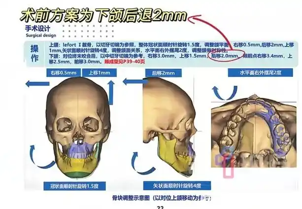 武汉大学口腔医院正颌手术问题_女孩正颌手术被做反 当事医生已停诊_武汉24岁女孩正颌手术维权